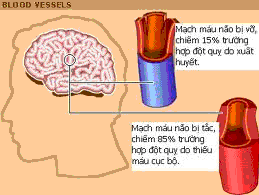 Tai biến mạch máu não - Chấn thương sọ não